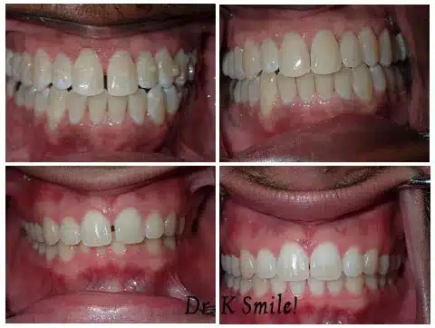 Before and After